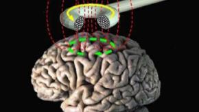 Transcranial_magnetic_stimulation