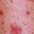 Vasculitis rash