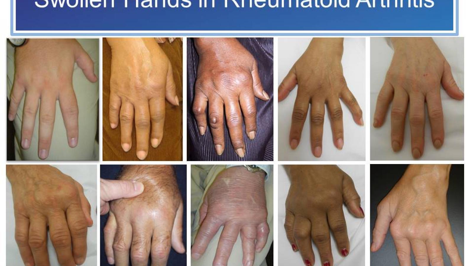 Swollen%20Hands%20RA.1.jpg