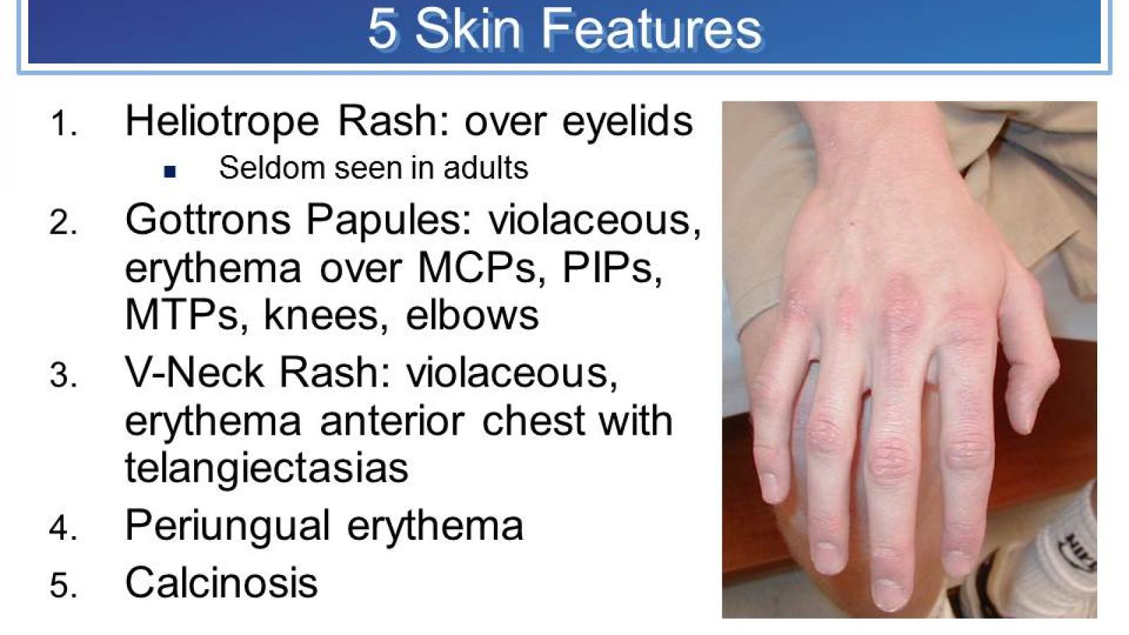 dermatomyositis%205%20skin%20manifestations.jpg