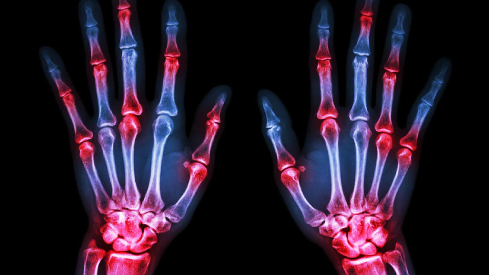 arthritis.RA_.Xray_.hands_.jpg (keep)
