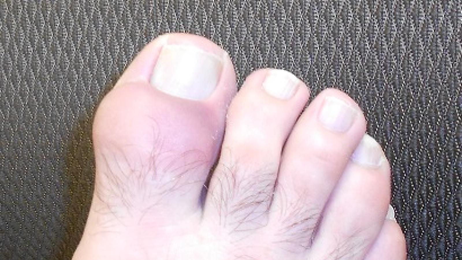 gout.bigtoe1.jpg (keep)
