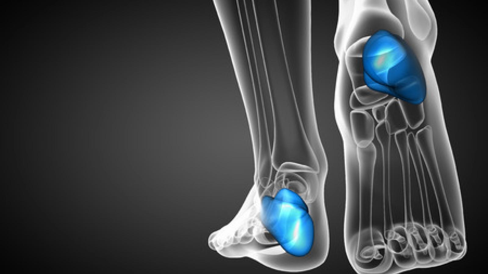 heel enthesitis spur calcaneal