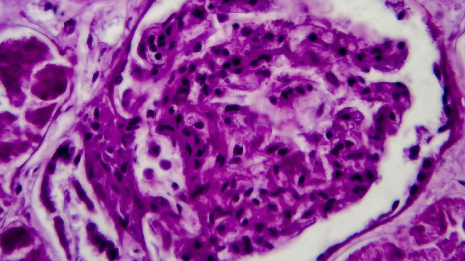 DPGN, lupus, nephritis, GN, glomerulonephritis, biopsy, kidney