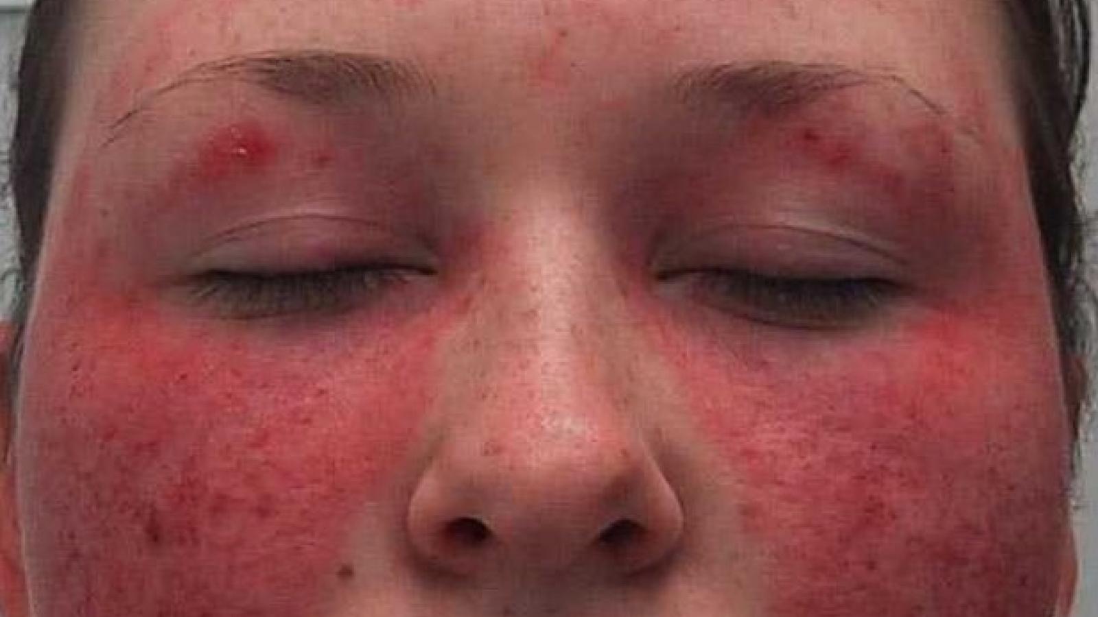 Malar,rash,SLE, Lupus