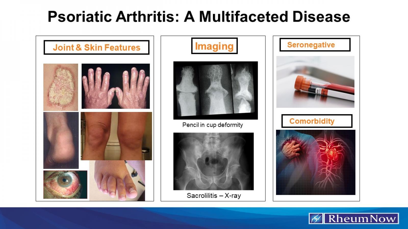 PsA Multifaceted Disease