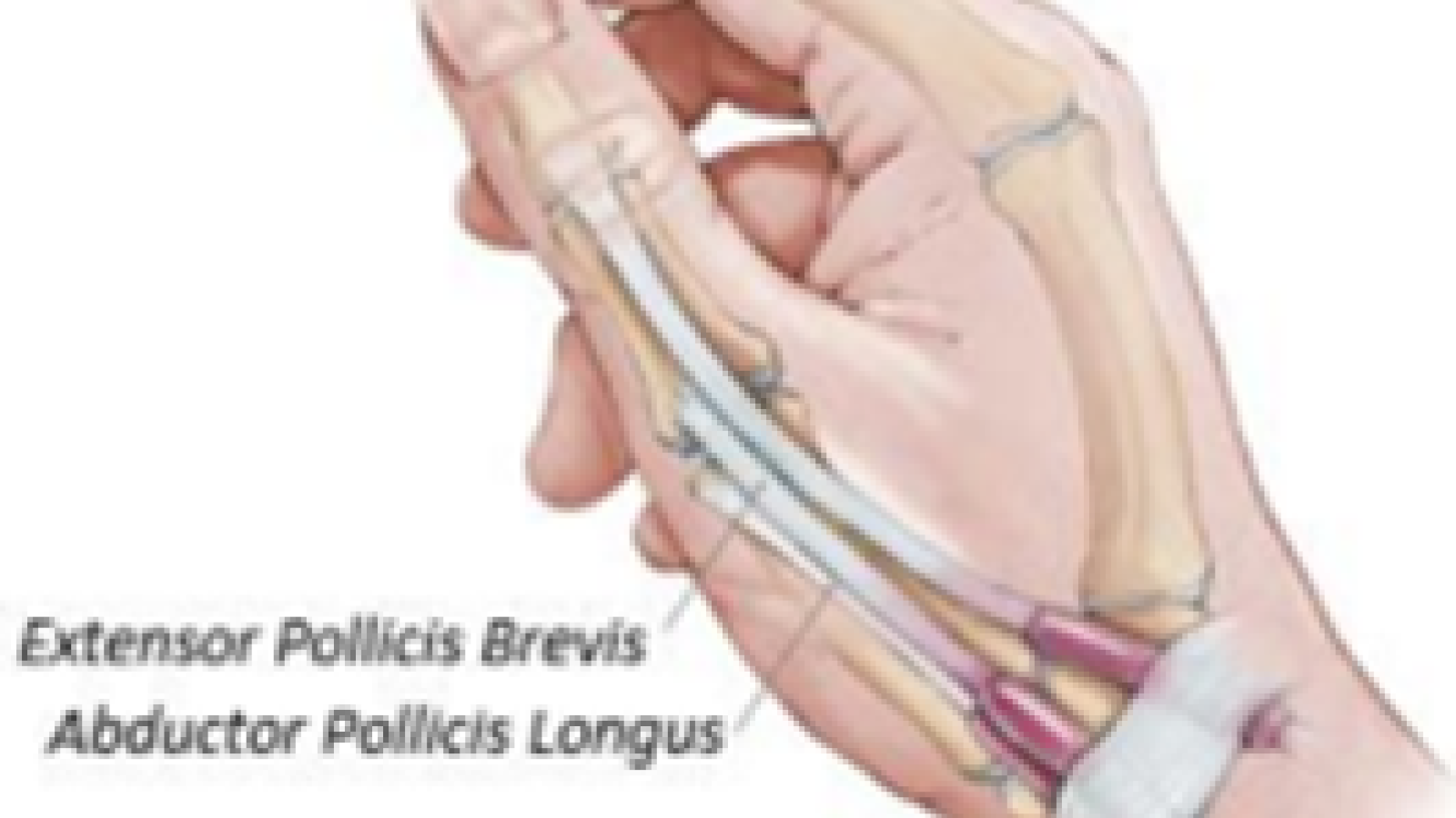 dequervain,tenosynovitis