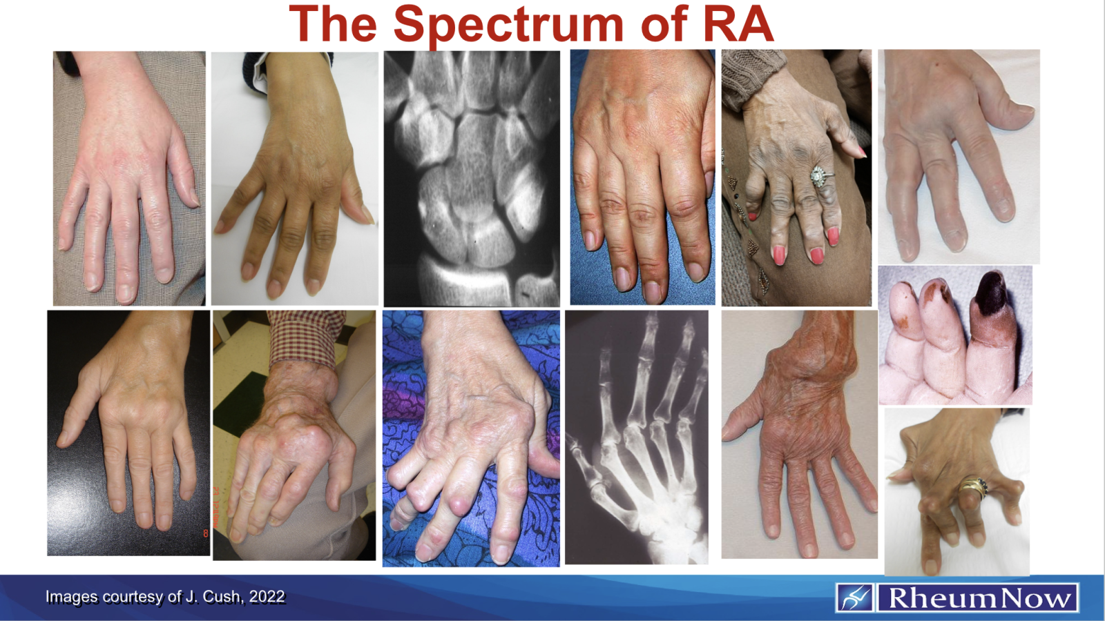 Spectrum of RA hands